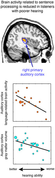 Brain activity related to sentence processing is reduced in listeners with poorer hearing